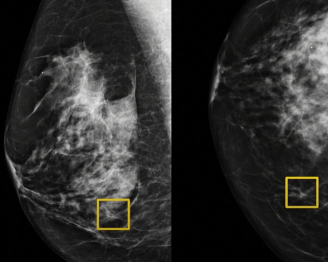 From CBC News: AI Detects Breast Cancer Better Than Doctors